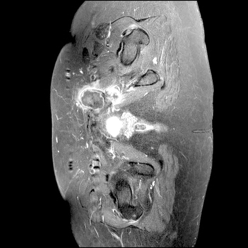 Figure 6. Axial MRI slice showing pelvic chondrosarcoma.
