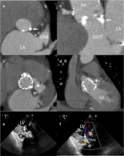 Figure 4. Aortic annulus rupture in an 88 year-old patient receiving a balloon-expandable transcatheter aortic valve prosthesis