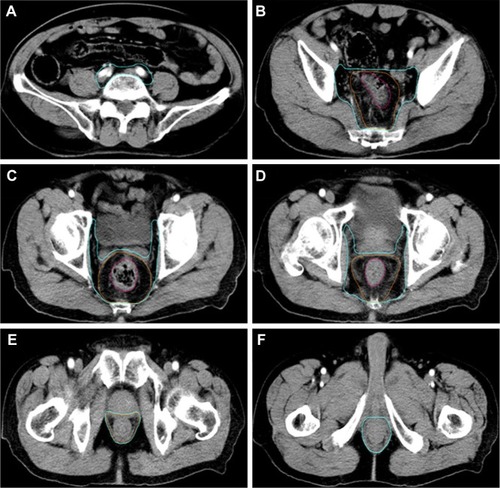 Figure 1 CTV-SR (blue), CTV-HR (orange), and GTV (red) on the simulation CT.