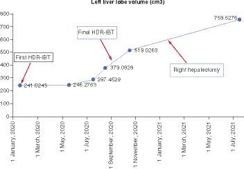 Figure 3. Changes in left lobe liver volume.HDR-IBT: High-dose rate interstitial brachytherapy.