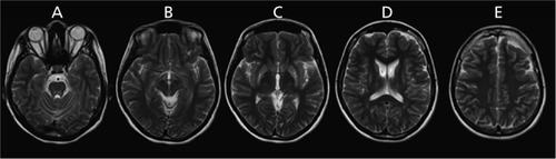 Figure 3 Representative images of T2-weighted sequences of Case 2. A. Upper pontine axial cut; there are hyperintensities over the dorsal pontine region B. Upper midbrain axial cut; there is normal looking red nucleus with hyperintensities over the area of substantia nigra C. Sylvian fissure axial cut; there are prominent hyperintensities over the putamen with areas of magnetic susceptibility artifacts, left more than the right D. Lateral ventricle region axial cut, continuous extensive hyperintensities over the putamen and caudate are seen E. Corona radiate axial cut, bilateral centum semiovale were spared of any signal abnormality