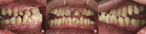 Figure 5 Initial intraoral photographs. (A) Right side view; (B) front view; (C) left side view.