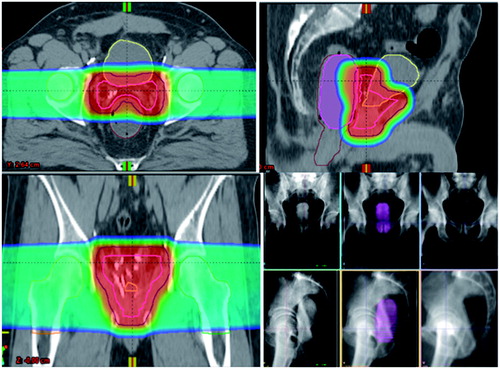 Figure 1. Representative dose color-wash distribution for post-prostatectomy PT using opposed lateral beams—contours: CTV (pink), PTV (navy), bladder (yellow), rectum (brown), right femoral head (orange), left femoral head (green), and ERB (purple). Daily imaging and alignment technique using the ERB with diluted contrast for visualization and alignment of the ARW with the PB CTV on daily kV-kV imaging.
