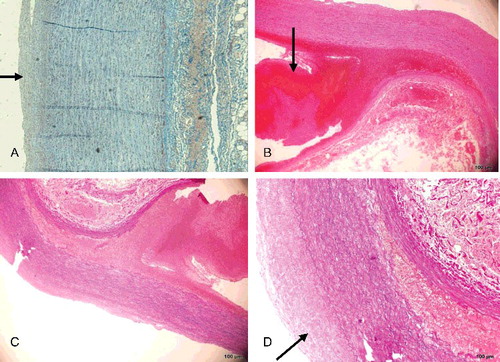 Figure 2. (A) The intact part of the aortic wall showed no histopathological change except slight intimal thickening (Masson trichrome×5). (B) Dissecting aneurysm of the abdominal aorta with longitudinal splitting of the vascular wall, ruptured adventitial layer and mural thrombus (black arrow) (HE×4). (C) Dissecting aneurysm of the abdominal aorta with longitudinal splitting of the vascular wall and splitting of elastic fibres (EvG×4). (D) Higher-power view of dissecting aneurysm of the abdominal aorta with evident thickened intima (black arrow) (EvG×10).