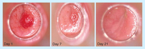 Figure 2. X-ray brachytherapy of a uT1N0 rectal cancer. Images were taken before the first fraction of 35 Gy (left), the second fraction of 30 Gy (middle, partial remission) and third fraction of 20 Gy (right, clinical complete remission) was delivered.