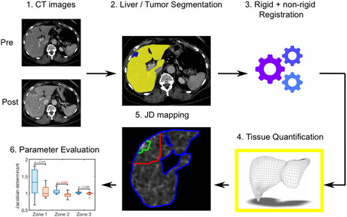 Figure 2. Schematic description of the postprocessing steps for evaluation of tissue shrinkage. 1: Export of pre- and post-interventional CT images. 2: Semi-automatic whole liver (yellow color-coded) and tumor (blue color-coded) segmentation. 3: Image registration. 4: Application of a postprocessing algorithm to quantify voxel wise the deformation volume of the liver tissue. 5: Calculation of JD maps in three defined anatomic regions (green zone = ablated tumor; red zone = 5cm tumor perimeter; blue zone = whole liver). 6: Evaluation of tissue shrinkage considering different patient and tumor settings.