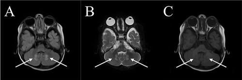 Figure 2 MRI (Plain) of the Brain. (A–C) are FLAIR-weighted, T2-weighted, and T1-weighted MRI respectively. (A and B) show hyperintensity in the bilateral dentate nucleus, whereas (C) shows hypointensity in the bilateral dentate nucleus (marked by white arrows).