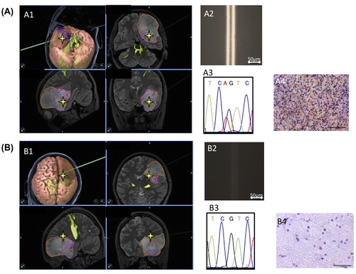 Figure 5. Tumor boundary detected using the immuno-wall assay. During tumor removal surgery in a patient, two specimens were collected. (A1, A2) A specimen from the center of the tumor tested positive in the immuno-wall assay. (B1, B2) In contrast, a specimen from the margins of the tumor, which appeared normal, tested negative. (A3, A4, B3, B4) The IDH1 status of these samples was confirmed using immunohistochemistry and DNA sequencing.