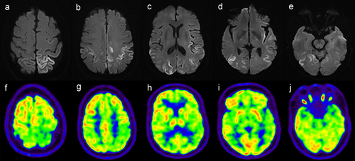 Figure 1. (a-e) Diffusion-weighted imaging. (DWI); (f-j) 18 F-FDG PET/CT imaging DWI showed restricted diffusion within the cortical ribbon of bilateral frontal, parietal, temporal, occipital lobes and left insular lobes where 18 F-FDG PET/CT demonstrated hypometabolism.