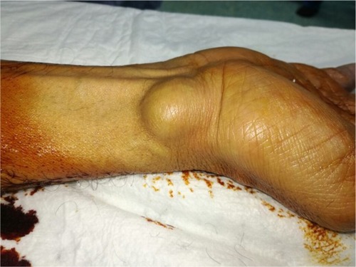 Figure 1 Right wrist swelling.