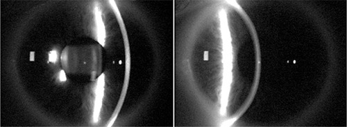 Figure 1 Slit-scanning technique performed by Orbscan.