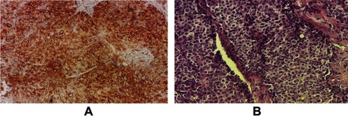 Figure 6 Immunohistochemistry of the TUBO tumor. (A) Brown colors indicate the HER2 receptor on the cell surface, (B) H&E staining of TUBO tumor.