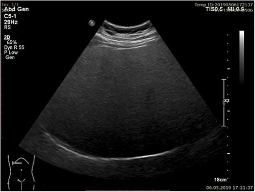 Figure 3 Severe steatosis (S3) bright liver with intense posterior.