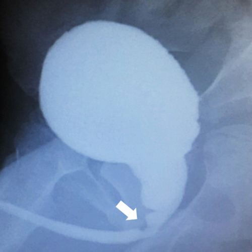 Figure 2 Radiological appearance of posterior urethral valve on voiding cystourethrography.