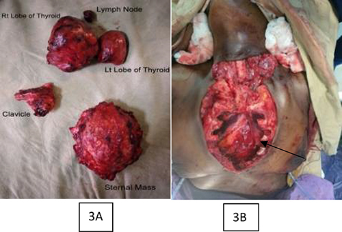 Figure 3 (A): Specimen of total thyroidectomy plus level 6 lymph node and the resected clavicular and sternal mass (B): Chest wall defect after sternectomy done.