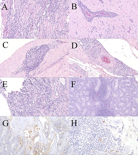 Figure 3. Haematoxylin and eosin (H&E) microscopic lesions and WNV immunohistochemistry (IHC) of experimental WNV-inoculated wild turkeys. (A) Heart; lymphoplasmacytic, histiocytic myocarditis overlay few degenerated cardiomyocytes (old group, 14 dpi, 20×, H&E). (B) Midbrain; lymphoplasmacytic perivascular encephalitis with microgliosis (old group, 14 dpi, 20×, H&E). (C) Caecum; lymphoplasmacytic typhlitis and ganglioneuritis (myenteric plexus) (old group, 14 dpi, 20×, H&E). (D) Proventriculus; serosal lymphoplasmacytic perivascular proventriculitis (old group, 14 dpi, 20×, H&E). (E) Ocular pecten-optic nerve; lymphoplasmacytic pectenitis and neuritis (old group, 14 dpi, 20×, H&E). (F) Testis; lymphoplasmacytic orchitis (old group, 14 dpi, 10×, H&E). (G) Ventriculus; WNV antigen within the cytoplasm of macrophages and lymphocytes in the lamina propria (young group, 14 dpi, 40×, IHC). (H) Lung; few macrophages and lymphocytes in bronchus-associated lymphoid tissue with intracytoplasmic WNV antigen (young group, 14 dpi, 40×, IHC).