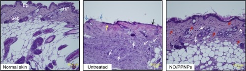 Figure 11 Histological sections of normal skin, untreated, and NO/PPNPs stained with hematoxylin and eosin.Notes: Histological analysis of BALB/c mice at day 7, scale bar =50 μm. The arrows colored with black, blue, yellow, white, and red indicate edema, ulceration, early epithelialization, mononuclear inflammatory cell, and fibroblast cell, respectively.Abbreviations: NO/PPNPs, NO-releasing PLGA-PEI nanoparticles; PLGA, poly(lactic-co-glycolic acid); PEI, polyethylenimine; NO, nitric oxide; HF, hair follicles; Epi, epidermis; Seb, sebaceous glands.