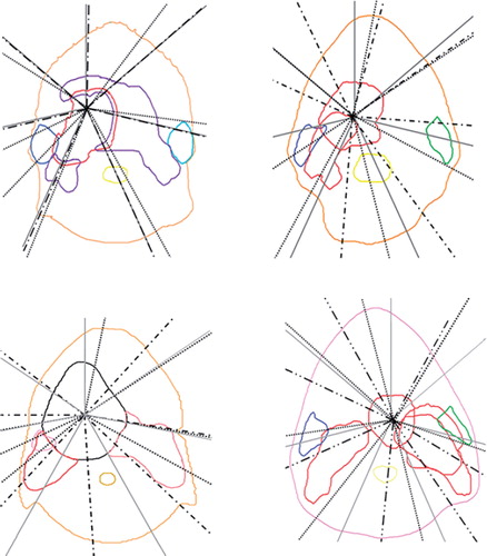 Figure 3. The beam geometries obtained using GAO in the OMP system (black dots), in the Eclipse system (black dashed lines) and the equidistant beam geometry (grey solid lines) for the four cases calculated as average beam geometries for all treatment plans generated. The colours for the ipsilateral parotid/PTV in the trade-off are for Case 1 (upper left) blue/ red, Case 2 (upper right) blue/red, Case 3 (lower left) pink/red and Case 4 (lower right) green/red.