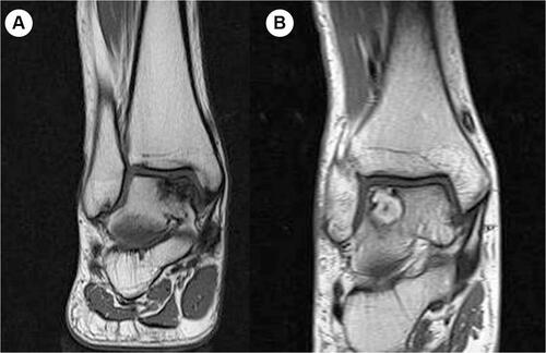 Figure 10 (A and B) Large-sized osteochondral lesion and subchondral cyst difficult to obtain successful regeneration of cartilage with only bone-marrow stimulation techniques.