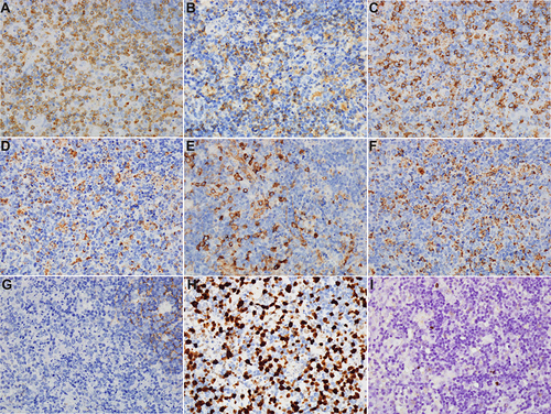 Figure 4 Immunohistochemical results of a lymph node ((A) CD3; (B) CD4; (C) CD8; (D) CD68; (E) CD123; (F) MPO; (G) CD21; (H) Ki-67; (I) EBER).