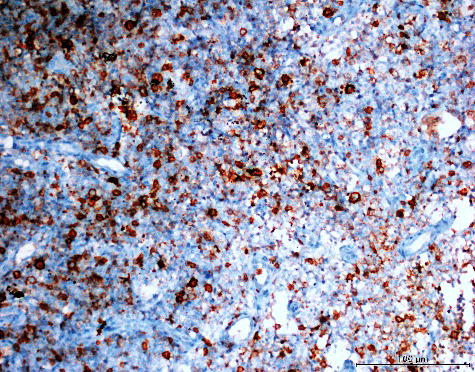 Figure 2. Focal (extensity score = 2) and moderate (intensity score = 2) expression of AQP3 in MPM (AQP3, 200×).