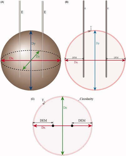 Figure 3. Schematic figures of ablation zones showing the measured diameters. (A) Three-dimensional figure of the spherical ablation zone. Two electrodes (E) are inserted with a 1-cm inter-electrode distance, and radiofrequency ablation is performed to create a spherical ablation zone. After ablation, the bovine liver blocks were cut first along the electrode tract and second in a transverse plane perpendicular to the first cut surface. From the first cut surface, the longest diameter perpendicular to the electrode tracts that would traverse the two electrode tracts is Dx (red), and the longest vertical diameter parallel to the electrode tract at the middle is Dy (blue). From the second cut surface, the diameter perpendicular to Dx at the midpoint is Dz. Dx: distance along x axis; Dy: distance along y axis; Dz: distance along z axis; E: electrodes. (B) Schematic figure of the first cut surface of the ablation zone showing xy plane. Two electrodes (E) are inserted in parallel. Dx is the longest diameter that traverses the two electrode tracts perpendicularly. Dy is the longest vertical diameter parallel to the electrode tracts, at the midline between the two electrodes. Distance between the electrode tract and the closest outer margin of the ablation zone along the x axis is DEM. The thickness of the peripheral red zone is T. (C) Schematic figure of the second cut surface of the ablation zone showing zx plane. RF electrode tracts are shown as black circles. The ablation zone consists of central white (pale pink) and peripheral red zones (dark pink), and the area of the ablation zone is the sum of the two zones. Circularity on zx plane was measured by drawing a region of interest along the outer margin of the ablation zone. Dx: distance along x axis; Dz: distance along z axis; DEM: Distance between the electrode tract and the closest outer margin of the ablation zone along the x axis; T: thickness of peripheral red zone.