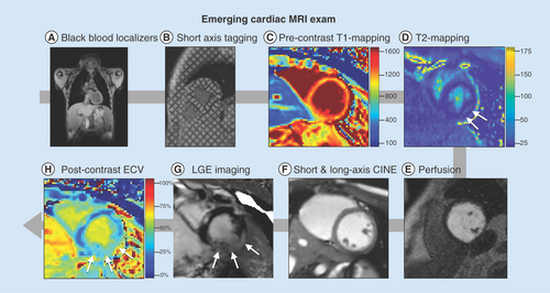 Figure 3.  An emerging cardiac MRI workflow designed for high-quality structural and functional imaging. (A) High-resolution, static, black-blood imaging to evaluate thoracic and cardiovascular anatomy (B) short and long axis tagged images for the computation of cardiac strain and twist, (C & H): pre- and post-contrast T1 mapping and extracellular volume for the assessment of cardiac structural changes, (D) perfusion imaging to ensure contrast injection, (E) T2 mapping and  apparent diffusion coefficient images for the assessment of cardiac structural changes, (F) dynamic (CINE) white-blood imaging (balanced steady-state free precession) of the left ventricular short and long axis to assess regional and global cardiac function and (G) post-contrast static late gadolinium enhancement for evaluating myocardial fibrosis.CINE: Dynamic images; ECV: Extracellular volume; LGE: Late gadolinium enhancement.