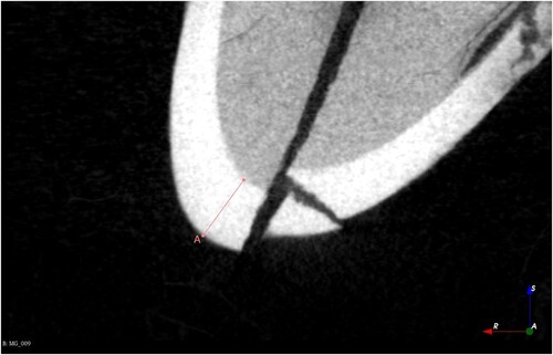 Figure 3. Measurement for enamel thickness categorisation.