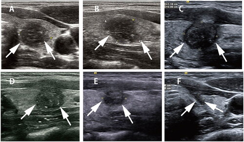 Figure 3. Imaging findings in a 30-year-old Woman with papillary thyroid cancer treated with radiofrequency ablation. The tumor located in the left lobe of the thyroid with a volume of 0.88 cm3 (arrow) is shown in the longitudinal (A) and transverse (B) planes on ultrasonography. The tumor volume decreased to 0.63 cm3 (arrow, C), 0.47 cm3 (arrow, D), and 0.33 cm3 (arrow, E), respectively, at 1, 3, and 6 months after radiofrequency ablation, and only the needle track was visible at 12 months (arrow, F).