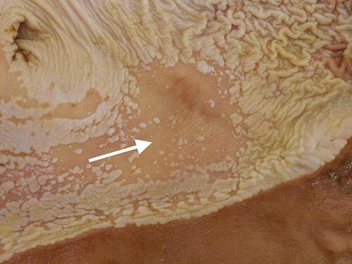Figure 4 Erosion (white arrow). Notice the focal region of squamous mucosa that is smooth and reddish/pink in appearance. This represents thinning of the squamous epithelium and loss of the keratinized layer. Image courtesy of Henny Martineau.