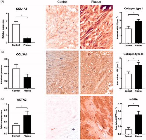 Figure 1. Relative gene expression to ACTB (β-actin), and representative pictures with quantification of immunohistochemical staining, both in tunica albuginea (control) and plaque. (A) COL1A1 gene and corresponding protein collagen type I. (B) COL3A1 gene and corresponding protein collagen type III. (C) ACTA2 gene and corresponding protein α-SMA. *p < .05 as determined by the Wilcoxon paired rank test. HPF: high-power field.