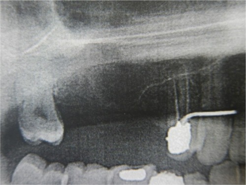 Figure 2 A preoperative panoramic radiograph was taken to detect the site of the fistula and the vertical bone height of the extracted tooth.