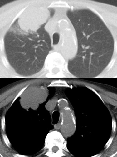 Figure 4 Sarcomatoid carcinoma appearing as a large nodular lesion of the right upper lobe with relatively well-defined margins at computed tomography of the thorax.