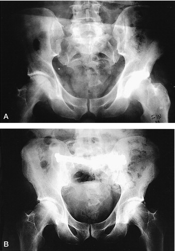 Figure 2. (A) A 49-year-old man had a major crushing injury, sustaining a type-C3 injury to the pelvis without any injury to the anterior part of the pelvic ring. (B) The bilateral fracture dislocation of the sacroiliac joint was treated with open reduction and iliosacral screw fixation.