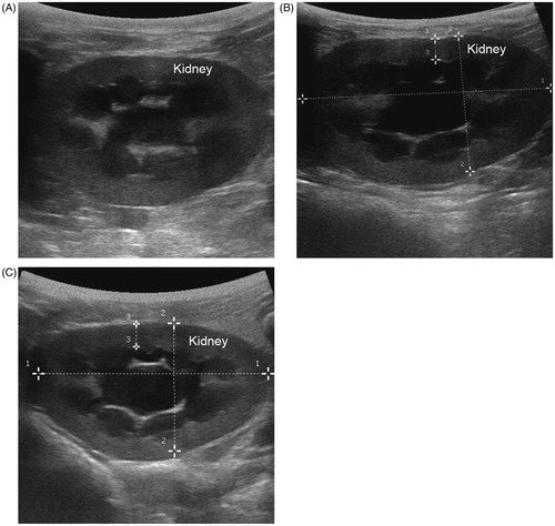 Figure 3. Postoperative ultrasonography of the kidney. (A) Ultrasonography of kidney in shame control group on the 10th day postoperatively. (B) Ultrasonography of kidney in PUUO group on the 10th day. The RCT decreased, while V increased into hydronephrosis. (C) Ultrasonography of kidney in RUUO group on the 20th day after relief.