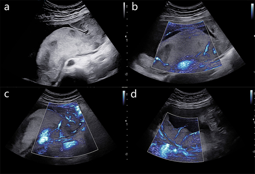 Figure 1 Ultrasonography was performed at 23 weeks of gestation. (a) The placenta was found to be attached to the left lateral and posterior wall of the uterus, exhibiting localized thickening. Within this area of thickening, there were observed inhomogeneous hypoechoic regions. (b) Superb Micro-vascular Imaging (SMI) revealed an abnormal echogenic region within the thickened placental tissue that exhibited a lack of microvascular blood flow signals, but demonstrated surrounding vascularity. Visually, this elliptical-shaped echogenic region was observed to be enveloped by microvascular blood flow. (c and d) Branched micro-vascular blood flow was observed in the normal placental tissue next to the lesion.