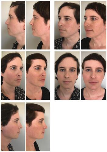 Figure 2 Facial transformation in a 40-year-old male-to-female transgender patient who received onabotulinumtoxinA and dermal fillers to feminize the face. Photographs were taken 2 months post-treatment. Patient images provided by Alexander Rivkin, MD.