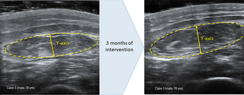 Figure 3. (a) measurement of muscle ultrasound images before intervention. Muscle thickness (Y-axis): 0.81 cm; muscle is in cm2: 2.47. (b) measurement of muscle ultrasound images at 3 month of intervention. Muscle thickness (Y-axis): 0.89 cm; muscle is in cm2: 2.85.