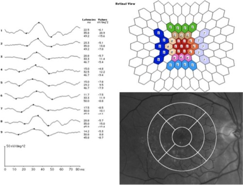 Figure 2 Response of the mfERG in the nine central areas and correlation between fundus pictures, OCT segments, and mfERG hexagons.