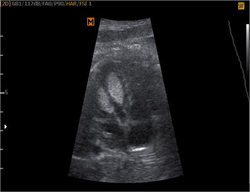 Figure 1 Two fetal left ventricular papillary muscle echogenic mass (rhabdomyoma) at 34 weeks.