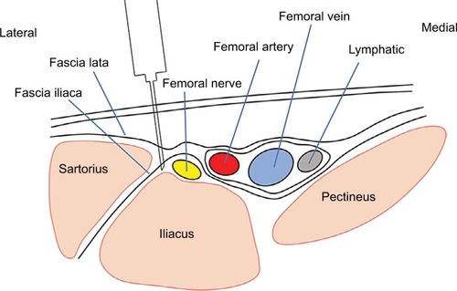 Figure 1 Anatomy of the fascia iliaca compartment block.