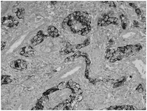 Figure 3. Renal biopsy revealed CD20 (+) lymphoma cells in renal arterioles, venules and capillaries.