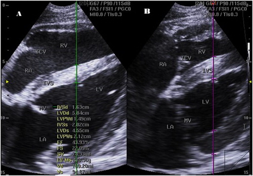 Figure 1. Right parasternal 2-D four-chamber long-axis view of small buffalo heart at the cordal (cordae tendinae) level in end diastole (a) and systole (b) showing IVSs, interventricular septal thickening in systole; LA, left atrium, LVIDd, left ventricular internal diameter in diastole; LVIDs, left ventricular internal diameter in systole; LVWd, left ventricular wall thickness in diastole; LVWs, left ventricular wall thickness in systole; RA, right atrium; RV, right ventricle; MV, mitral valve; TCV, tricuspid valve.