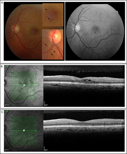 Figure 2 Main retinal findings and OCT follow-up patient 2 (A–C). (A) Colour fundus photography and red-free imaging of the left eye of a male patient revealing a peripapillary and macular flame-shaped haemorrhage (black arrow). Vasoactive pharmacological support was not necessary during hospitalisation. (B) Intraretinal cysts in the outer nuclear layer with 41-day after symptoms. (C) OCT 68-days after symptoms without intraretinal cysts.