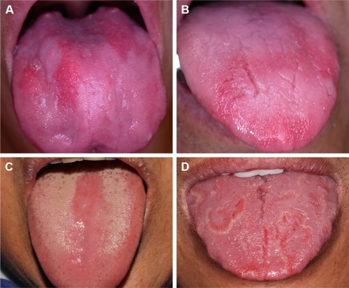 Figure 2 Different oral manifestations of B12 deficiency and other conditions.