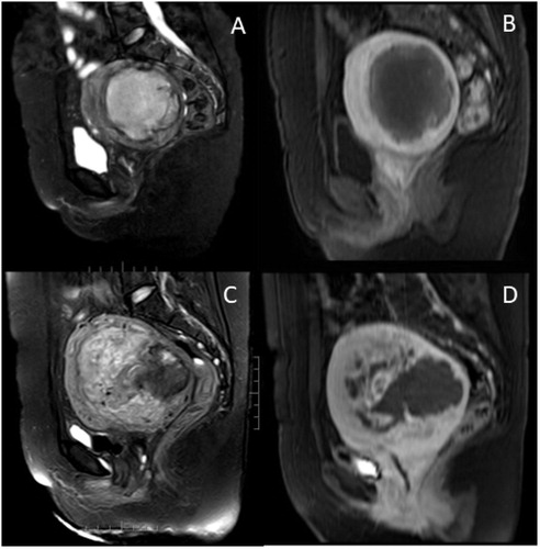 Figure 2. A 37-year-old patient came for HIFU treatment. (A). Pre-HIFU (T2WI) MRI showed a hyperintense mass with an irregular margin. (B) Pre-HIFU contrast-enhanced MRI showed central non-enhancement of the lesion; she was misdiagnosed as degeneration of uterine fibroids and had HIFU treatment. (C) T2WI obtained 10 months after HIFU showed an ill-defined mass of heterogeneous signal intensity. (D) Contrast enhanced MRI obtained 10 months after HIFU showed irregular enhancement of the lesion. The recurrent mass was suspected to be uterine sarcoma. The diagnosis was histologically confirmed after surgery.