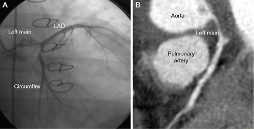 Figure 2 Coronary angiogram and chest computed tomography.