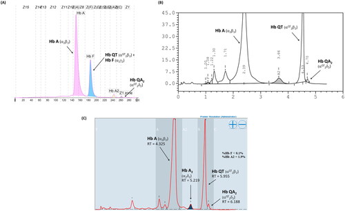 Figure 2. Hb Separation profiles of the heterozygous Hb Q-Thailand using (A) capillary electrophoresis, (B) VARIANT II HPLC, and (C) Premier Resolution HPLC.