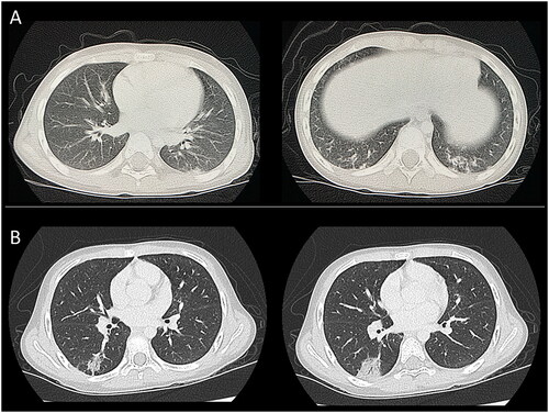 Figure 1. Computed tomography images. (A) Computed tomography image of case 1 revealing areas of consolidation with ground-glass opacity. (B) Computed tomography of case 2 in which an infiltrate with an air bronchogram was observed in the peripheral region, indicating organizing pneumonia.