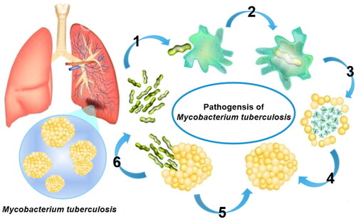 Figure 1. TB pathogenic mechanism.Note: M. tuberculosis escapes the influence of host immune defenses by the (I) circumvention of phagocytic fusion and phagocytic destruction, (II) neutralization of the acidic environment, (III) inhibition of apoptotic-envelope formation, and (IV) suppression of plasma-membrane repair, causing the spread of infection after macrophage necrosis, (V) suppressing the activation of the immune cells and (VI) restricting the pro-inflammatory responses.